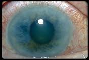 Obat Tradisional Mata Glaukoma