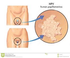 Cara Alami Menghilangkan Virus HPV