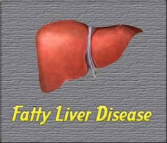 Obat Fatty Liver Adalah